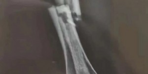 【千亿体育】断腿?网传广州队前锋帕尔曼江参加阿图什杯时，遭小腿骨折重伤