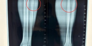 【千亿体育】伤情报告：王刚左小腿中上段腓骨裂纹骨折
