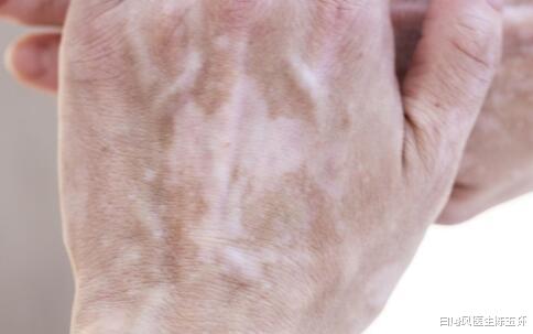 要怎么做才能从根本上预防白癜风疾病?做好这5点