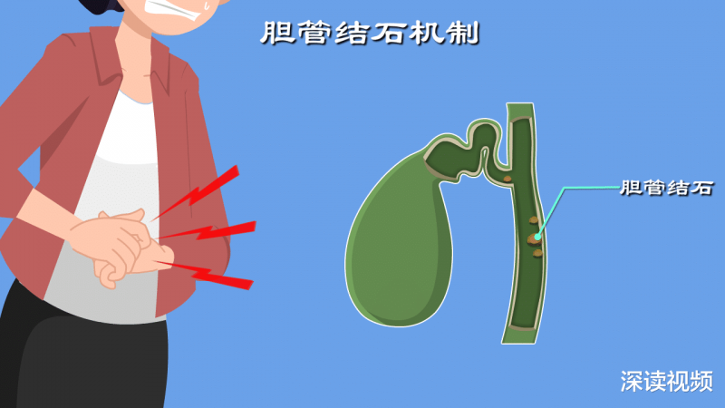 厌油恶心、腹泻、没胃口，看看你的胆汁是不是被胆管结石堵住了？